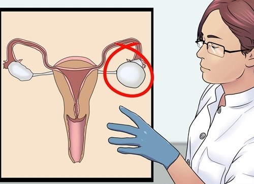 Những dấu hiệu đơn giản nhận diện u nang buồng trứng