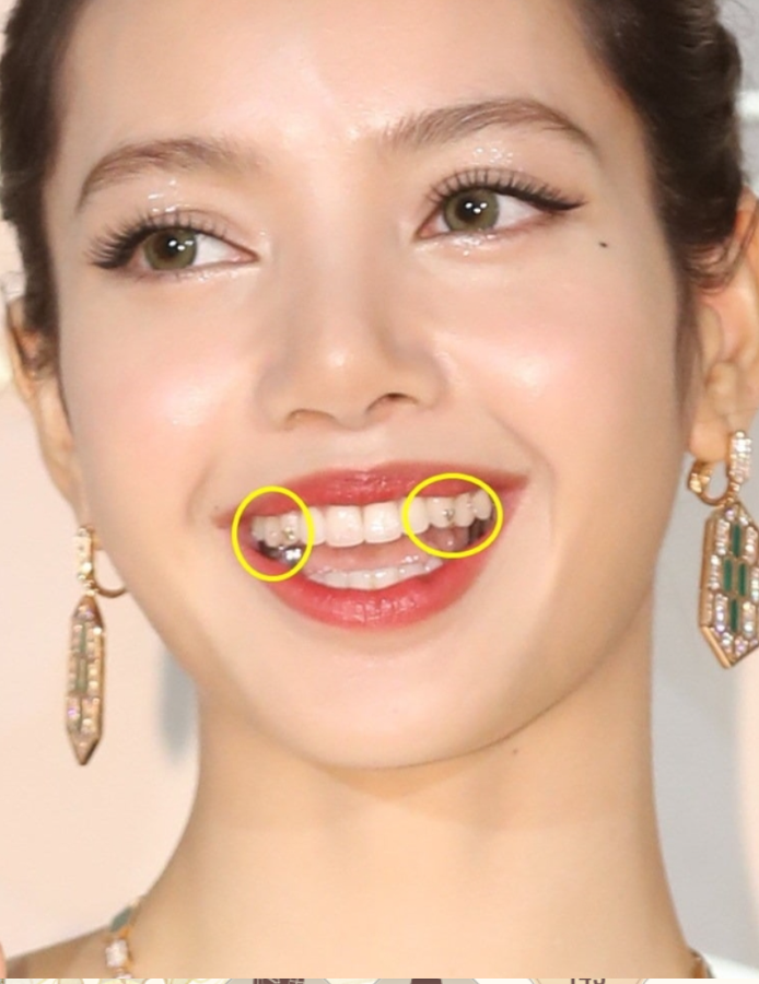 Cẩn thận với trend răng đính đá của Lisa